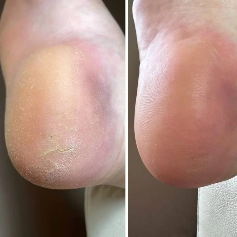 Resultum Anti Crack Cream Jojoba – Crema reparadora para grietas en manos y pies con aceite de jojoba