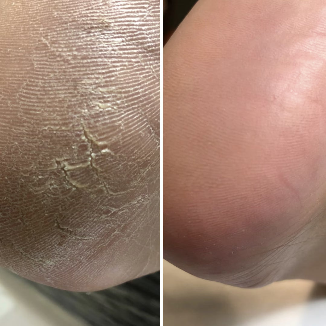 Resultum Anti Crack Cream Jojoba – Crema reparadora para grietas en manos y pies con aceite de jojoba