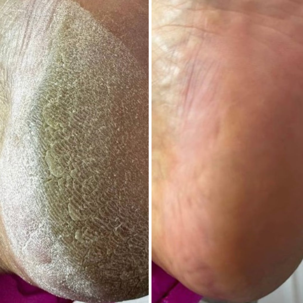 Resultum Anti Crack Cream Jojoba – Crema reparadora para grietas en manos y pies con aceite de jojoba