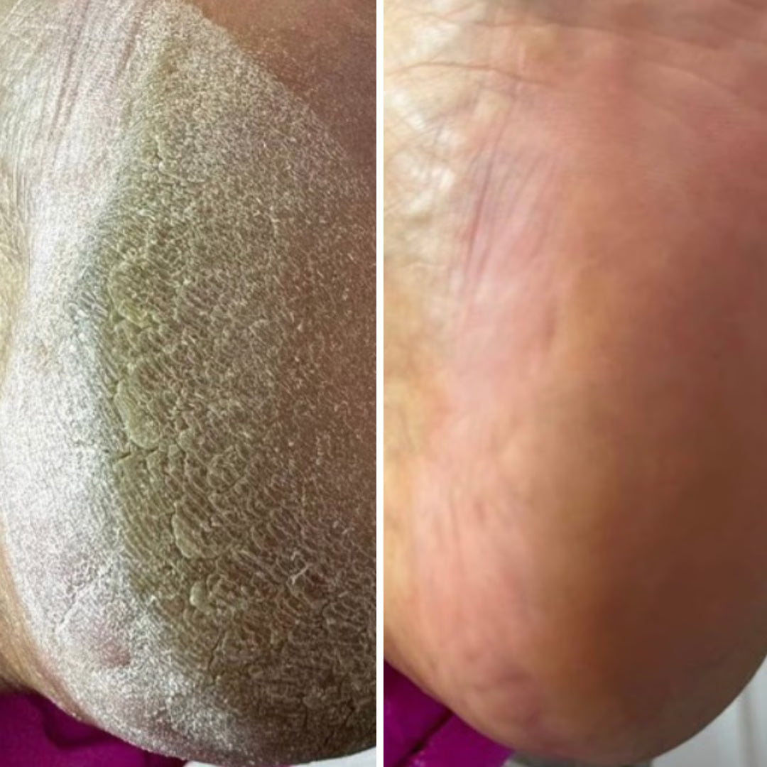 Resultum Anti Crack Cream Jojoba – Crema reparadora para grietas en manos y pies con aceite de jojoba