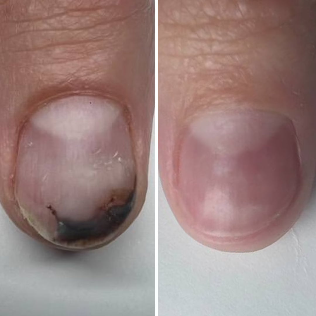 Resultum Onistopix Lotion – Loción regeneradora para uñas