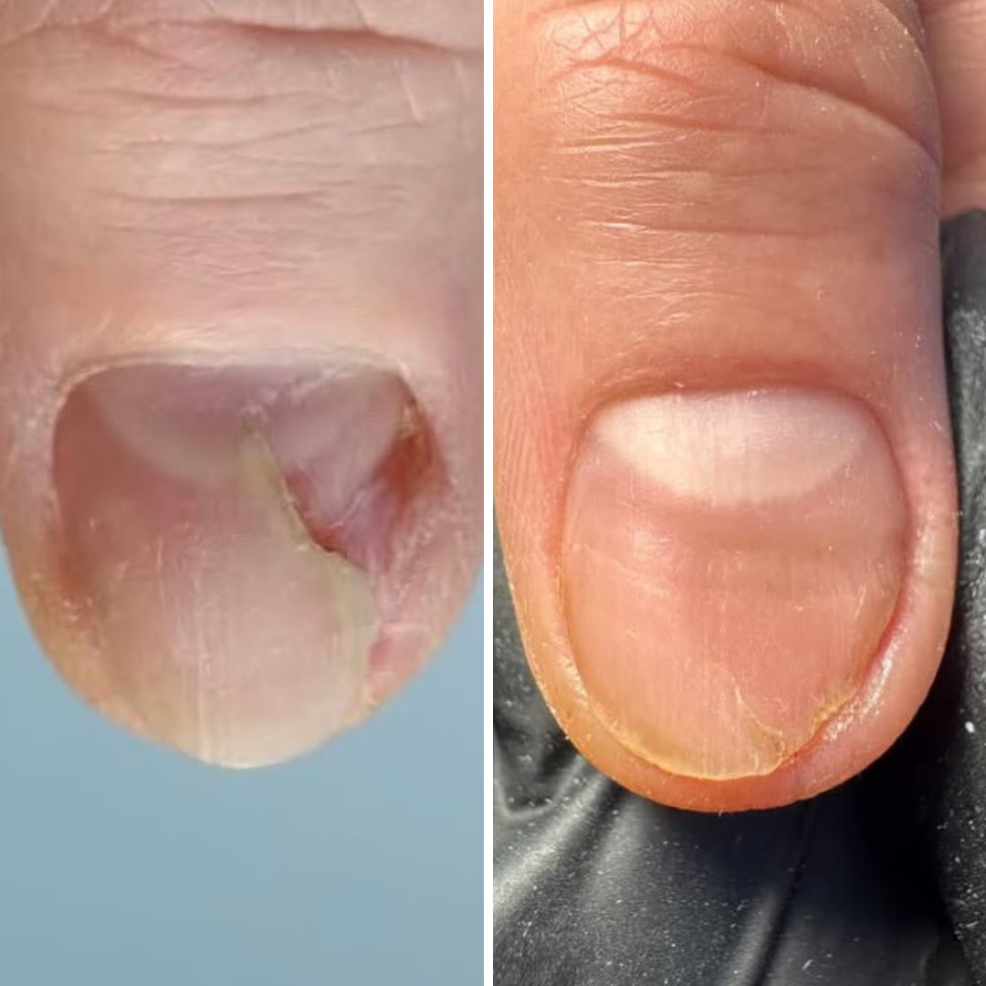 Resultum Onistopix Lotion – Loción regeneradora para uñas